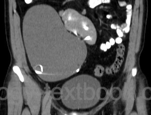 figure extrarenal pyelocalyceal system in crossed renal ectopia with hydronephrosis