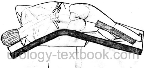 figure Flank incision: patient positioning and skin incision