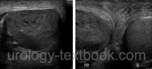 figure Testicular ultrasound imaging of a several-day-old testicular torsion