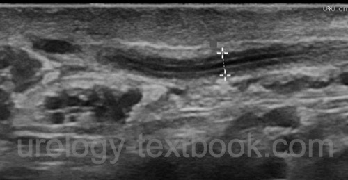 ultrasound imaging of funiculitis